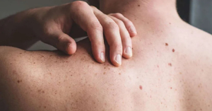 Se confirmaron en México 18 nuevos casos de viruela símica