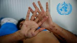 Estos estados han reportado casos de viruela del mono