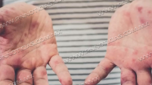 Se confirman los primeros casos de Coxsackie en Nuevo Laredo: alerta sanitaria en Tamaulipas