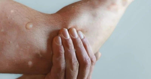 Un hombre falleci&oacute; a causa de la viruela del mono en M&eacute;xico