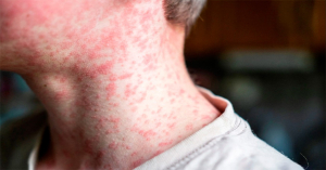 “Mete SS en cintura” brote de sarampión