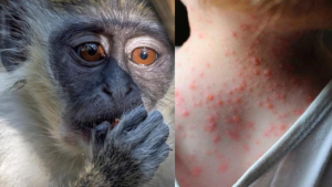Nueve casos de viruela de mono se confirman en Jalisco