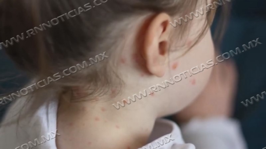 Nuevo Laredo se mantiene sin casos de sarampión y refuerza acciones preventivas con campaña de vacunación