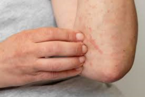 Dermatitis at&oacute;pica, enfermedad cr&oacute;nica que afecta a millones de mexicanos, &iquest;Te pasa?