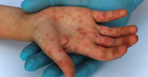 Suman 126 casos de sarampi&oacute;n en M&eacute;xico