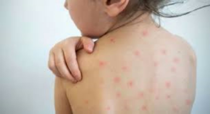 Solo 70% de los niños, protegidos contra sarampión