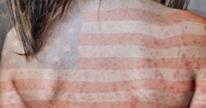 Estados Unidos emite alerta sanitaria por el contagio de sarampi&oacute;n, &iquest;esto afectar&aacute; a M&eacute;xico?